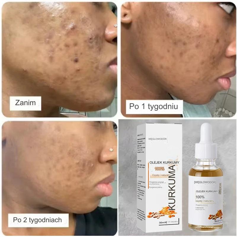 Bonatura+™️ Serum do twarzy z kurkumą | Odśwież swoją skórę i pozbądź się ciemnych plam na stałe!