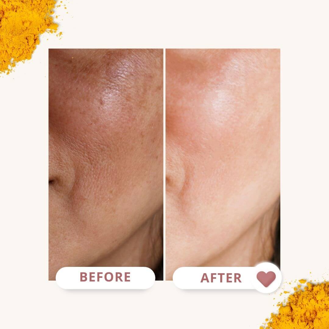 Bonatura+™️ Serum do twarzy z kurkumą | Odśwież swoją skórę i pozbądź się ciemnych plam na stałe!