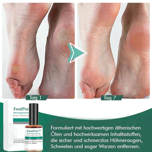 FootPro™️ Żel do usuwania kukurydzy