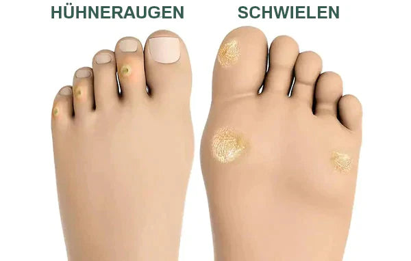 FootPro™️ Żel do usuwania kukurydzy