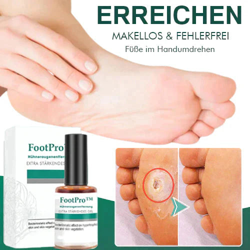 FootPro™️ Żel do usuwania kukurydzy