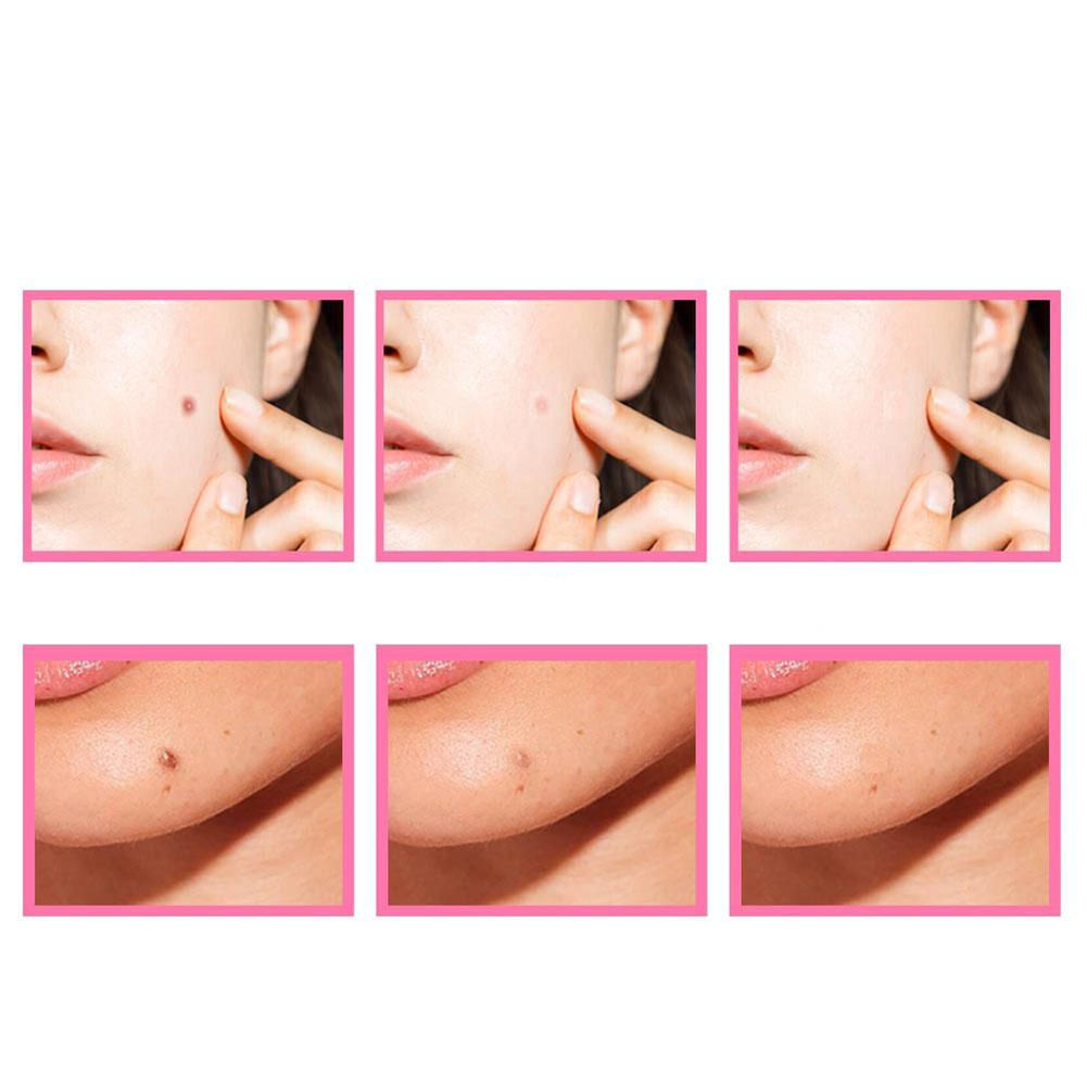 HerbCare™ Organiczne serum na skazy skórne | Usuń trwale brzydkie plamy skórne!