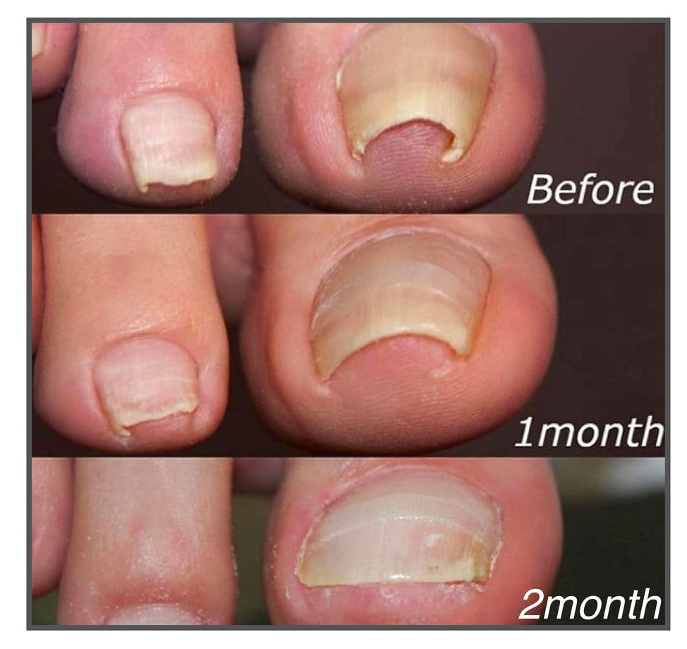 ToeFix+ Plastry na paznokcie | Skuteczna pomoc w walce z wrastającymi paznokciami!