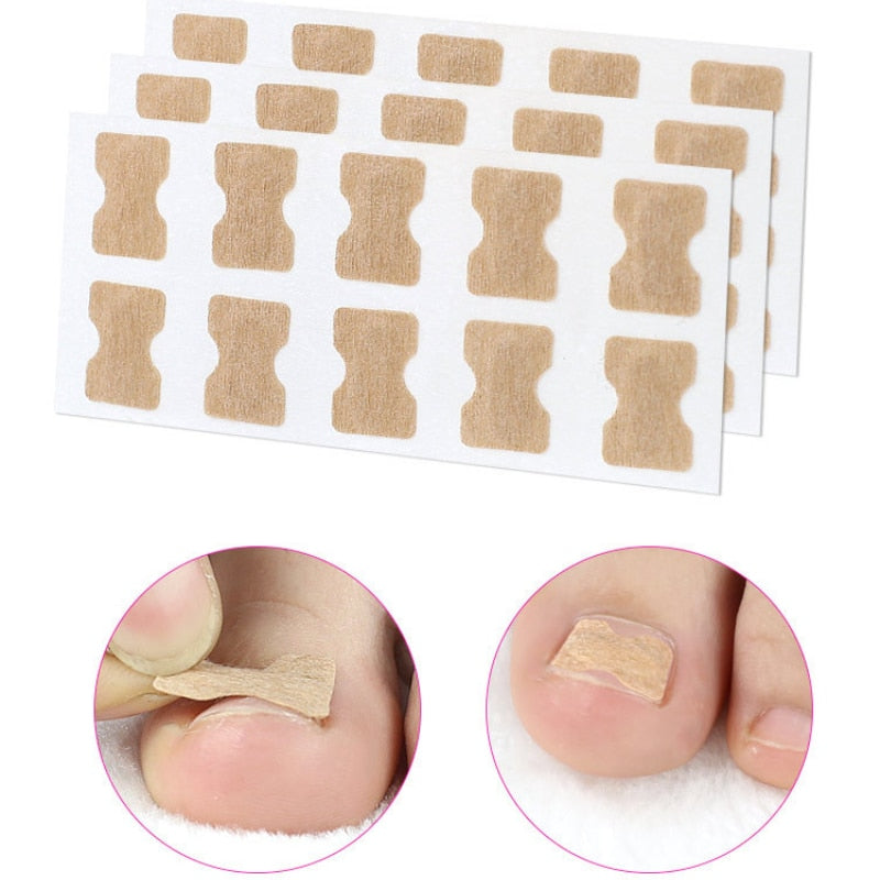 ToeFix+ Plastry na paznokcie | Skuteczna pomoc w walce z wrastającymi paznokciami!