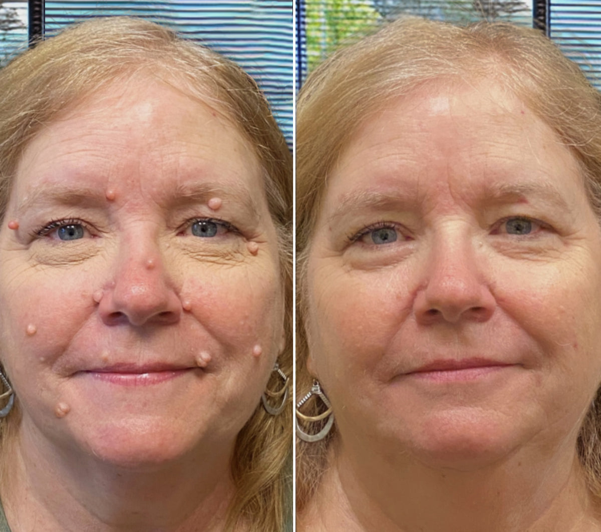 ClearRay™ Długopis do usuwania brodawek