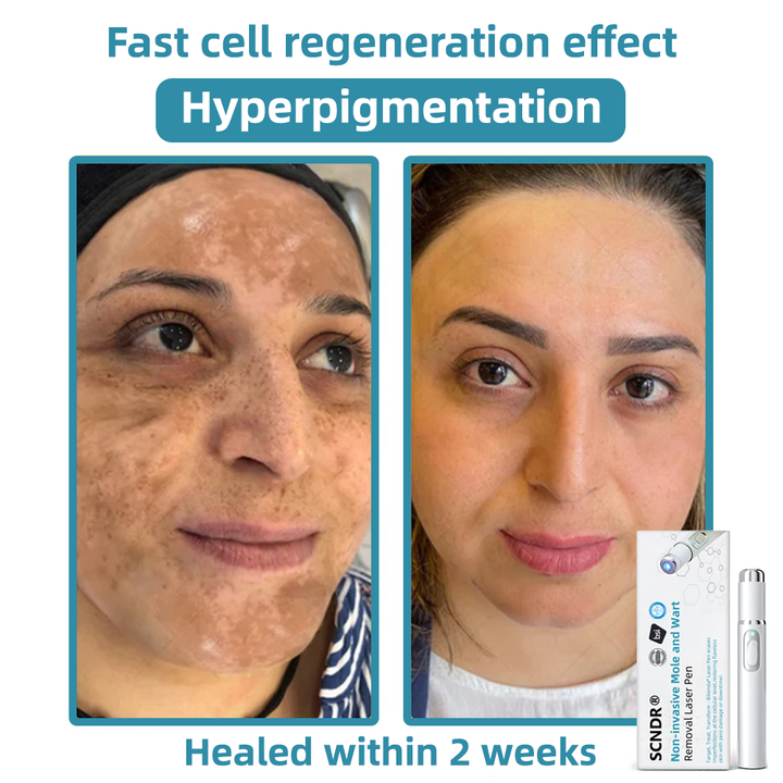 ClearRay™ Długopis do usuwania brodawek