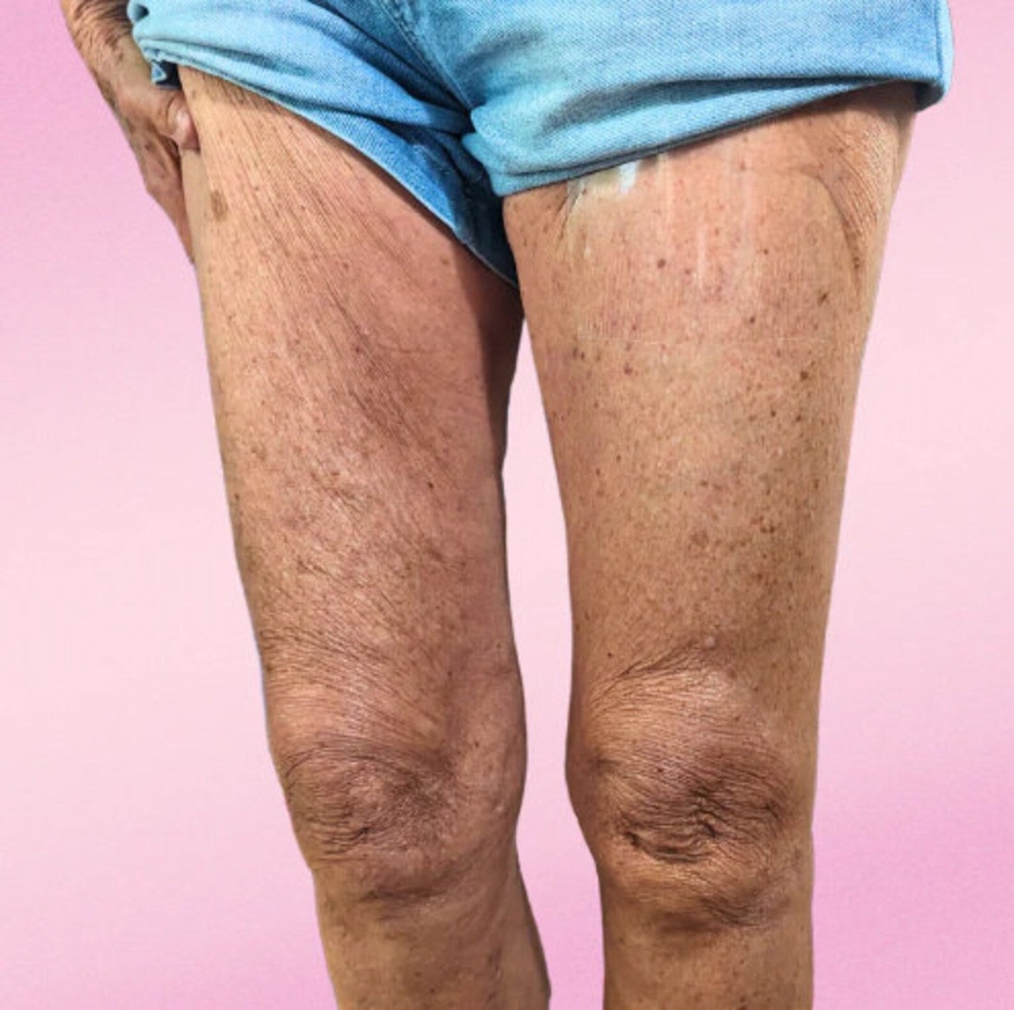 Invisilift™ Niewidoczne plastry ujędrniające skórę