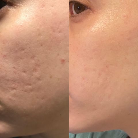 RejuvePatch™ Wielorazowe plastry na niedoskonałości twarzy