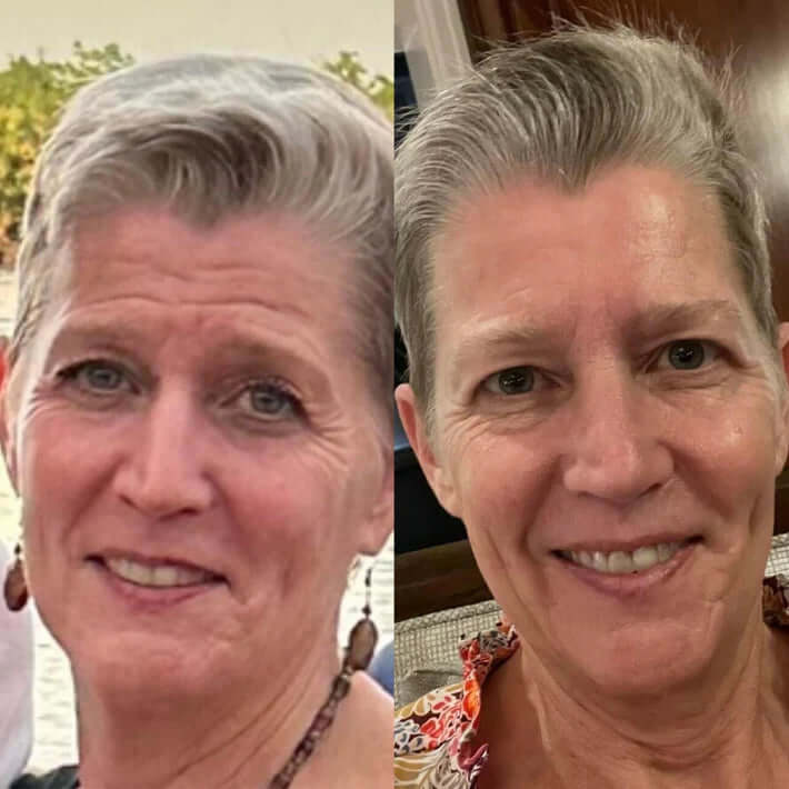 RejuvePatch™ Wielorazowe plastry na niedoskonałości twarzy